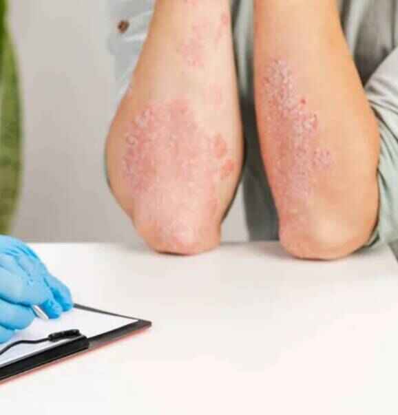 Skin Psoriasis Treatment